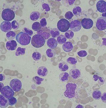 英国赫尔约克医学院发现白血病细胞的遗传倾向