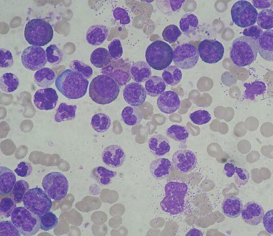 英国赫尔约克医学院发现白血病细胞的遗传倾向