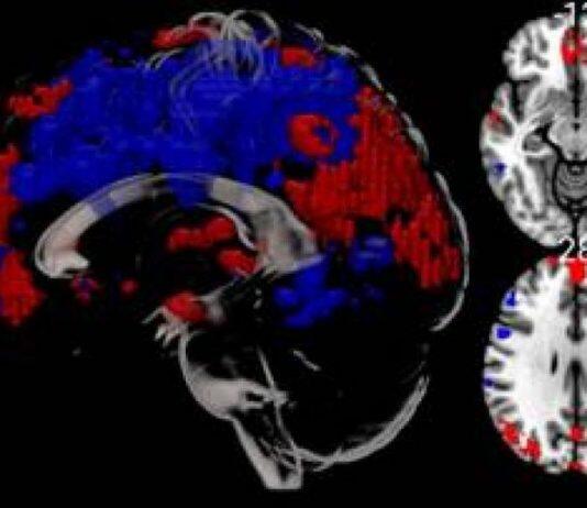 英国伯恩茅斯大学完成首例核磁共振_MRI脑部科研扫描