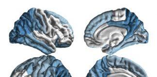 美国南加州大学研究所启动全球帕金森病研究